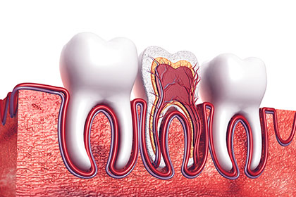 虫歯や歯周病は生活習慣と関連します