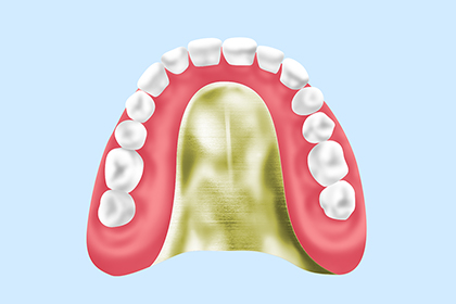 ゴールド床義歯