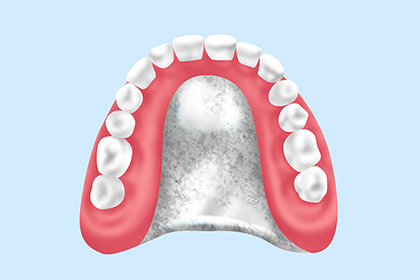 チタン床義歯