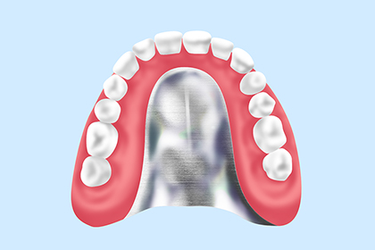 コバルトクロム床義歯